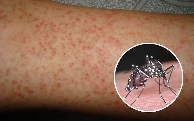 Những dấu hiệu của bệnh sốt xuất huyết