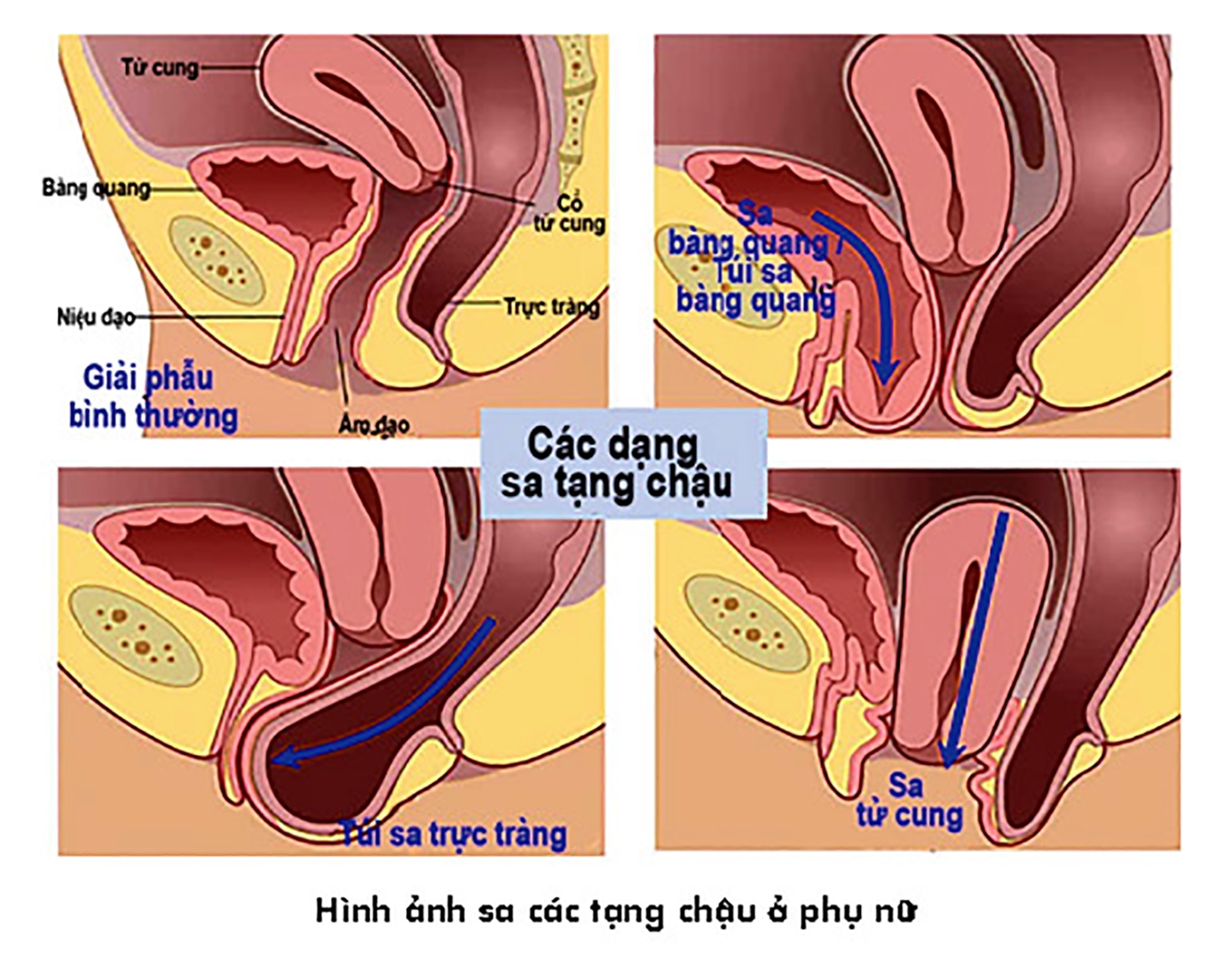 sa tang chau benh ly gay nhieu mac cam cho phu nu