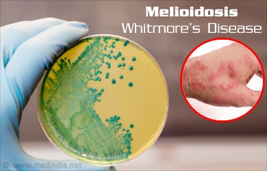 bệnh Whitmore (hay tên gọi khác là Melioidosis) là một bệnh nhiễm trùng ở người và động vật do vi khuẩn Burkholderia Pseudomalle gây ra. 