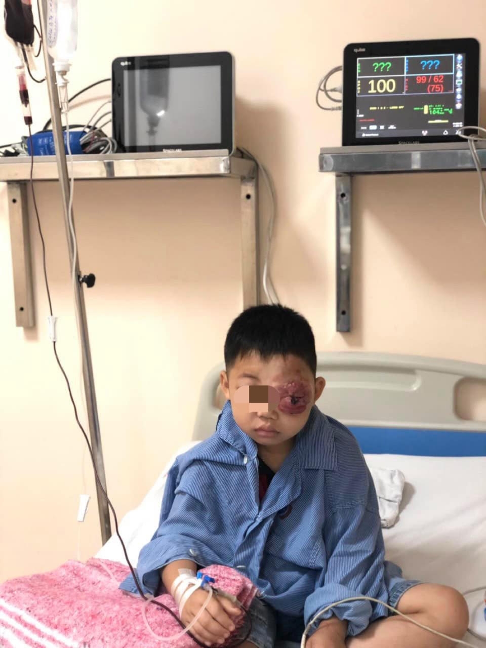 Bệnh viện K phẫu thuật thành công u máu khủng cho cậu bé 8 tuổi người dân tộc Dao